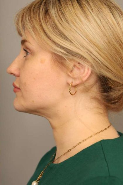 Neck Liposuction / Chin Liposuction Before & After Patient #1703
