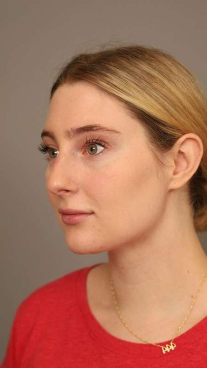 Neck Liposuction / Chin Liposuction Before & After Patient #1734