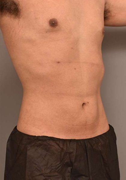 Liposuction For Men Before & After Patient #2369