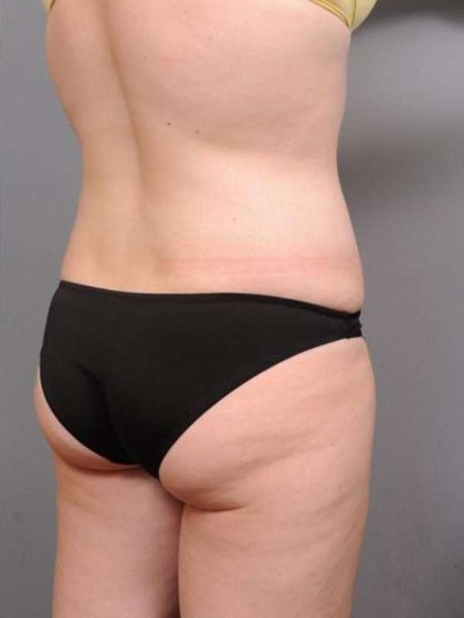 Tummy Tuck Before & After Patient #463