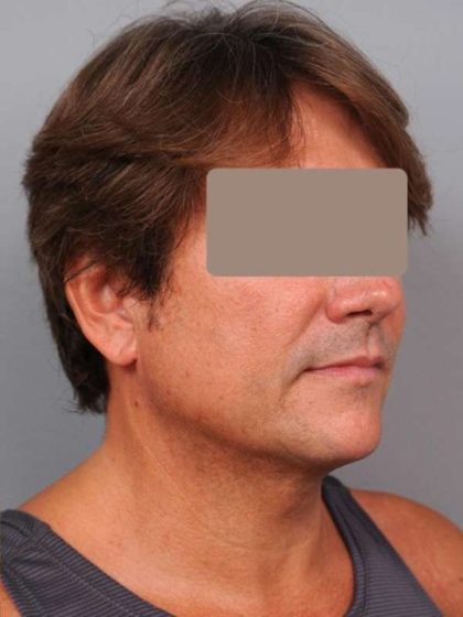 Neck Liposuction For Men Before & After Patient #2419