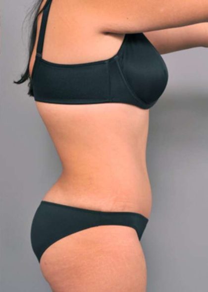 Tummy Tuck Before & After Patient #515