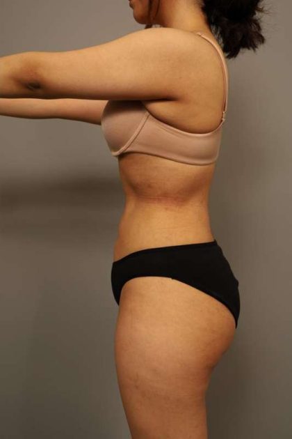 Liposuction Before & After Patient #563