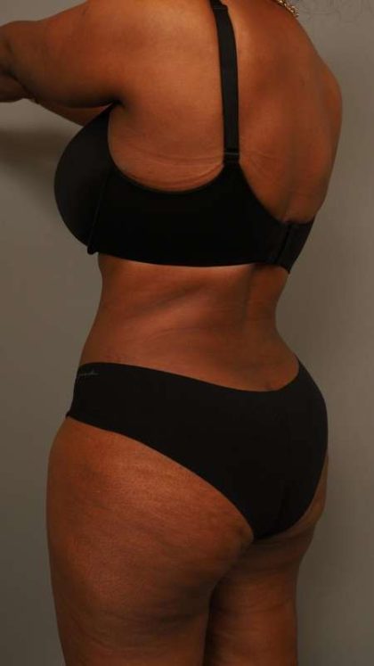 Tummy Tuck Before & After Patient #574