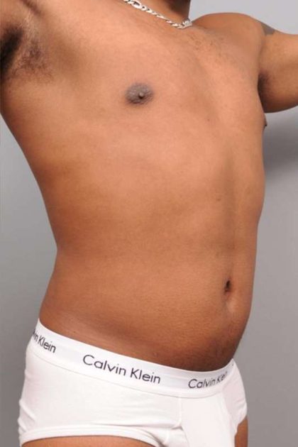 Liposuction Before & After Patient #648