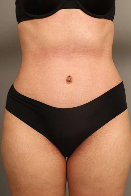 Tummy Tuck Before & After Patient #238
