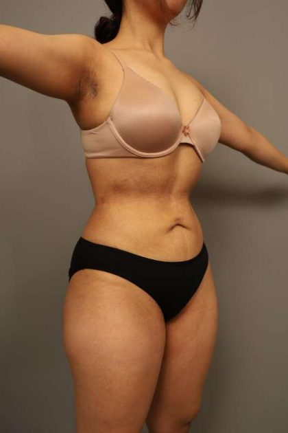 Liposuction Before & After Patient #563