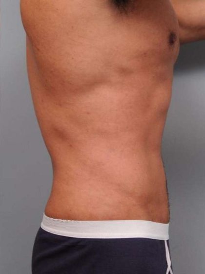 Liposuction Before & After Patient #783
