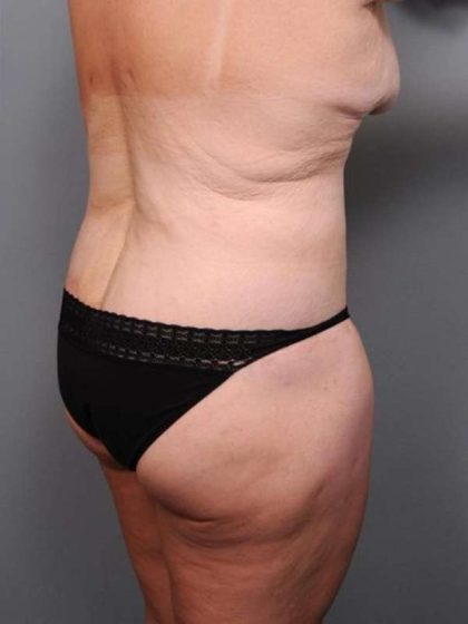 Lower Body Lift Before & After Patient #1027