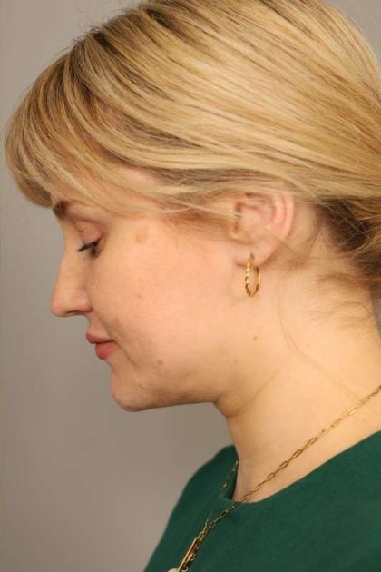 Neck Liposuction / Chin Liposuction Before & After Patient #1703