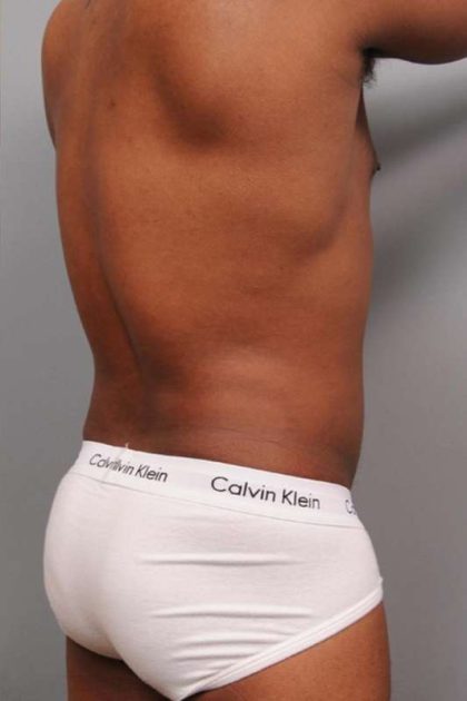 Liposuction For Men Before & After Patient #2330