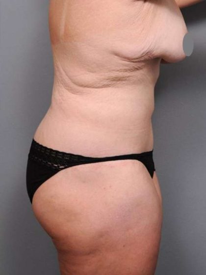 Lower Body Lift Before & After Patient #1027