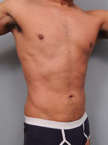 Liposuction Before & After Patient #783