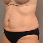 Tummy Tuck Before & After Patient #287