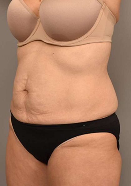 Tummy Tuck Before & After Patient #287