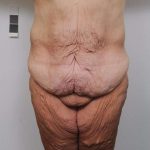 Lower Body Lift Before & After Patient #985