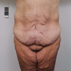Lower Body Lift Before & After Patient #985