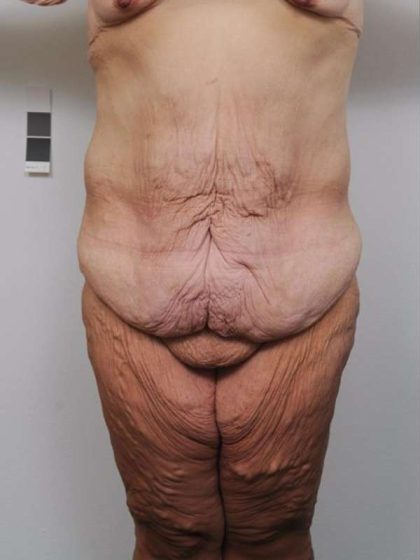 Lower Body Lift Before & After Patient #985