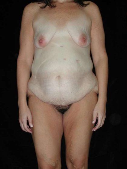 Lower Body Lift Before & After Patient #999