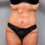 Lower Body Lift Before & After Patient #1010