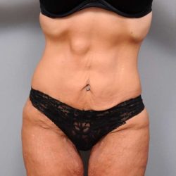 Lower Body Lift Before & After Patient #1010