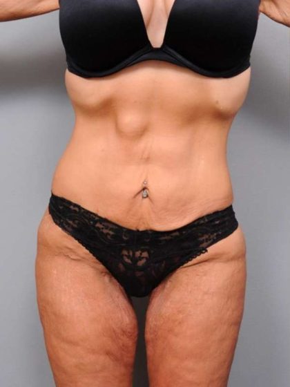 Lower Body Lift Before & After Patient #1010