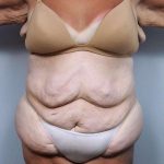 Lower Body Lift Before & After Patient #1027
