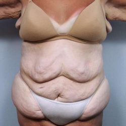 Lower Body Lift Before & After Patient #1027