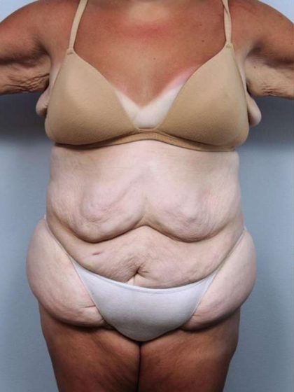 Lower Body Lift Before & After Patient #1027