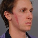 Scar Revision Before & After Patient #1033