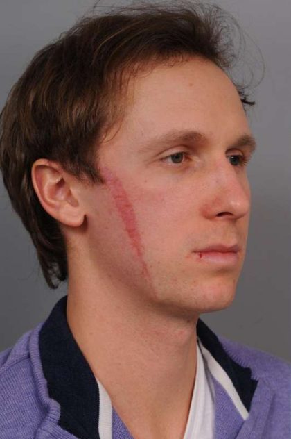 Scar Revision Before & After Patient #1033