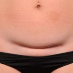 Scar Revision Before & After Patient #1041