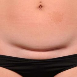 Scar Revision Before & After Patient #1041