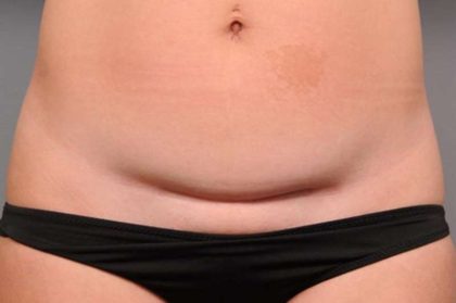 Scar Revision Before & After Patient #1041
