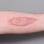 Scar Revision Before & After Patient #1044