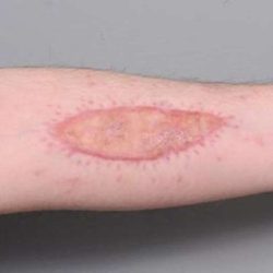 Scar Revision Before & After Patient #1044