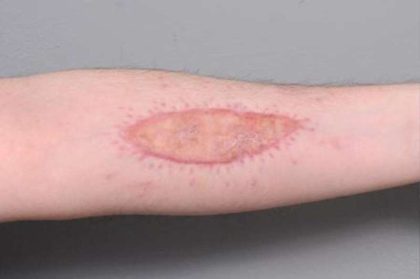 Scar Revision Before & After Patient #1044