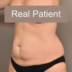 Tummy Tuck Before & After Patient #296