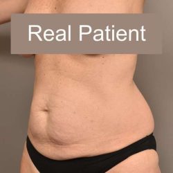 Tummy Tuck Before & After Patient #296