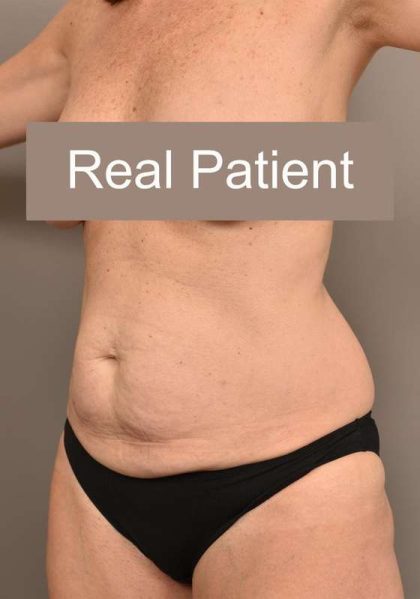 Tummy Tuck Before & After Patient #296