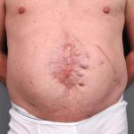 Scar Revision Before & After Patient #1047