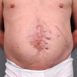 Scar Revision Before & After Patient #1047