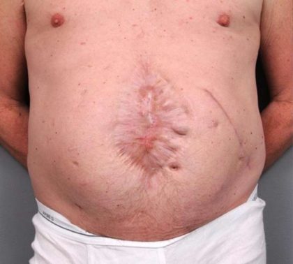 Scar Revision Before & After Patient #1047
