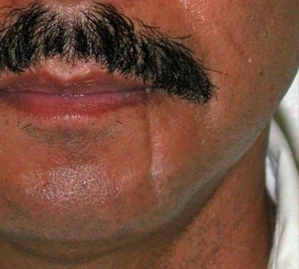 Scar Revision Before & After Patient #1053