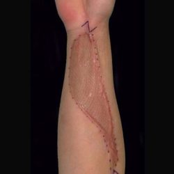 Scar Revision Before & After Patient #1056