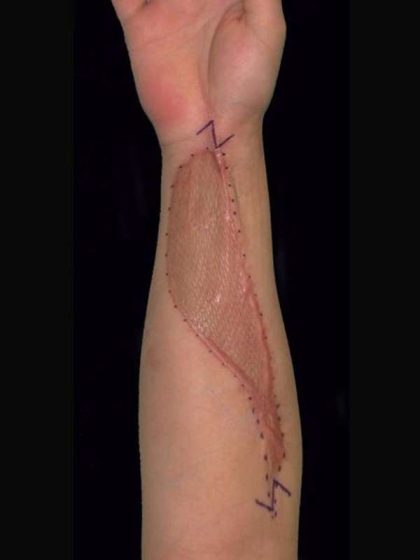 Scar Revision Before & After Patient #1056