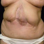 Scar Revision Before & After Patient #1059