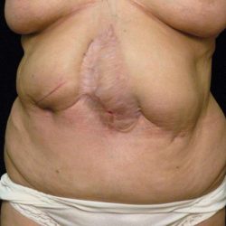 Scar Revision Before & After Patient #1059