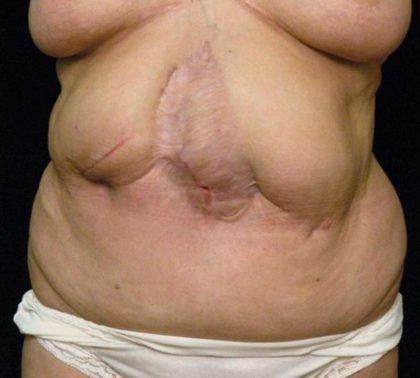 Scar Revision Before & After Patient #1059