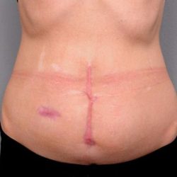 Scar Revision Before & After Patient #1062